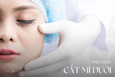 Phẫu thuật cắt mí dưới